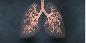 倪海厦：治肺癌的方法和掌握病情演变