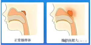 倪海厦人纪实践 调理40天，小侄女的腺样体肥大好了80%…